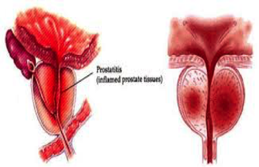 prostatitis2